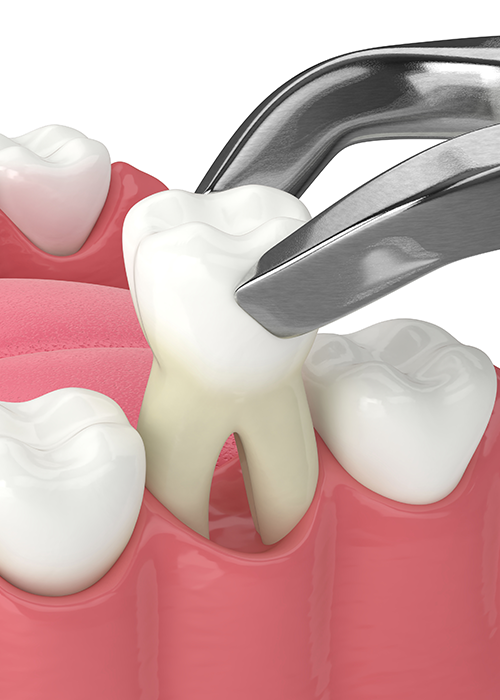 A 3D illustration of a tooth being placed.
